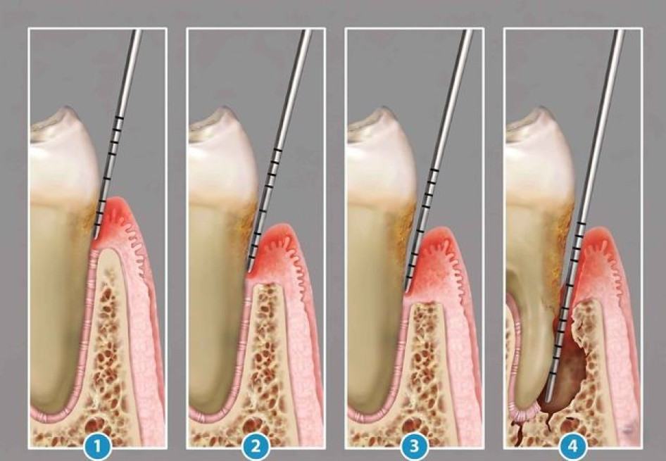 Időskorban a fogágy betegségek pusztítanak