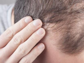 Hajbeültetés modern megoldásokkal: FUE és FUT eljárások